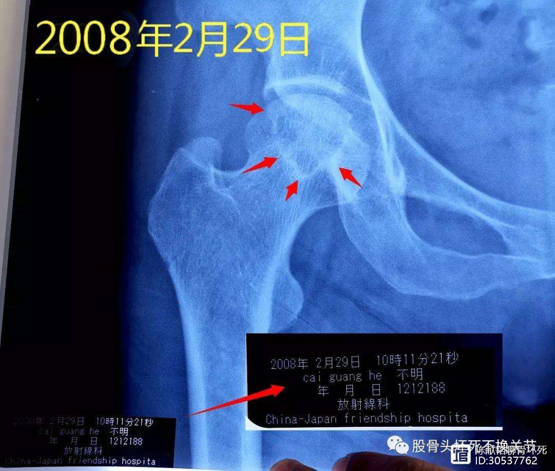 湘潭人工骨头医保报销多少(人工骨头医保报销多少比例)